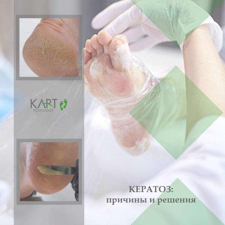 КЕРАТОЗ: причины и решения - Косметика КАРТ